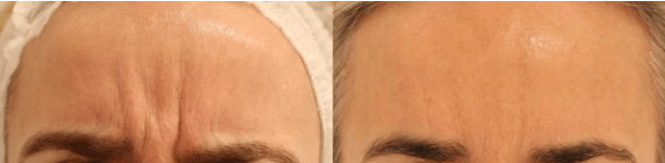 antes y despues tratamiento con botox