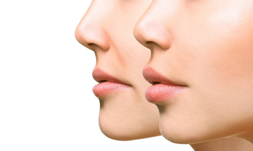 diferencias entre perfilado y relleno de labios